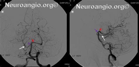 Cerebral Angiogram Anatomy - Anatomical Charts & Posters