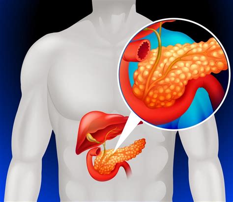 Understanding Pancreatic Cancer Causes and Treatments