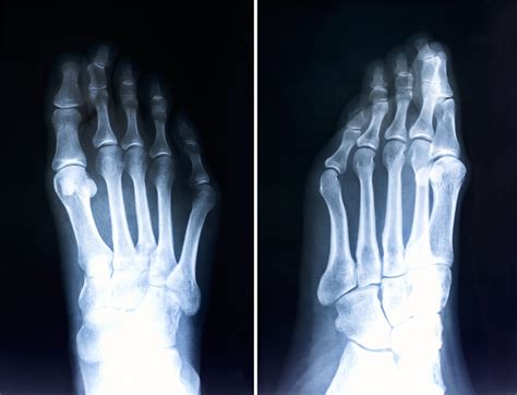 Types of Foot Deformities | Joint Replacement Institute