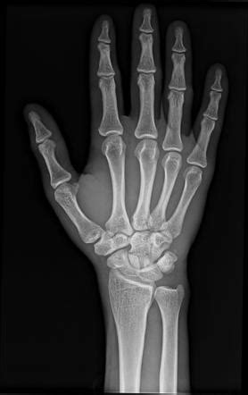 Carpal Bone Fracture