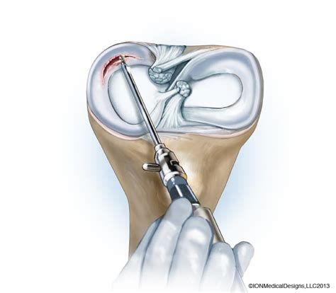 Meniscus Repair - Joint Preservation Center