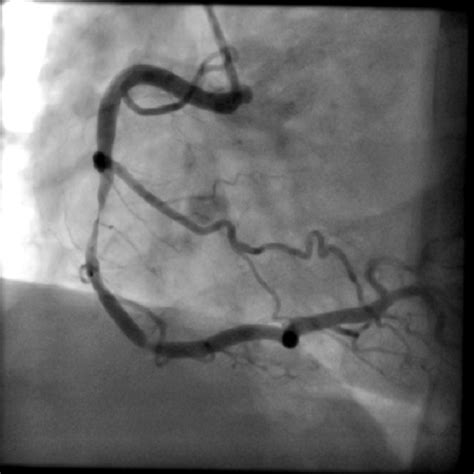 Coronary Angiography - Concord Cardiology