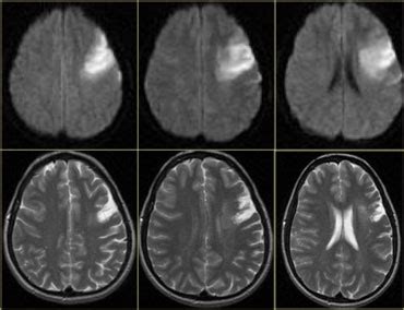 Stroke Brain Mri