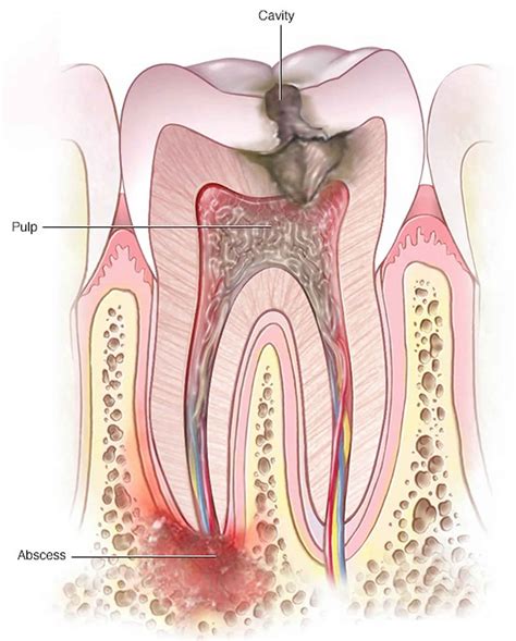 Periapical abscess causes, symptoms, diagnosis, treatment & prognosis