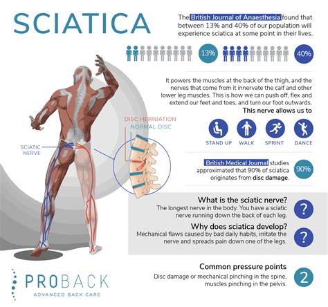 What is Sciatica? Sciatica Diagnosis & Treatment at Proback in London