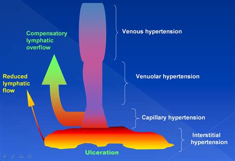 Pathogenesis of the venous ulcer – JOSEF PFLUG VASCULAR LABORATORY