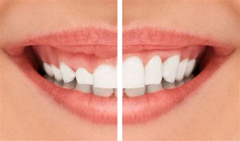 Gum Recontouring Service Los Angeles | Dental Emergency 24/7