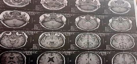 Brain MRI Showing Partial Empty Sella Features, with Enhanced Fluid ...