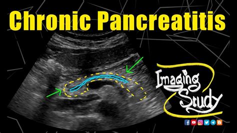 Chronic Pancreatitis || Ultrasound || Case 168 - YouTube