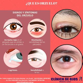 Clínica de Ojos Oftalmic Láser: QUE ES UN ORZUELO