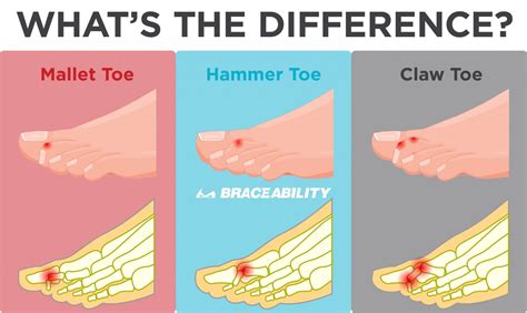 What are the symptoms and causes of Hammer's toe and Mallet Toe ...