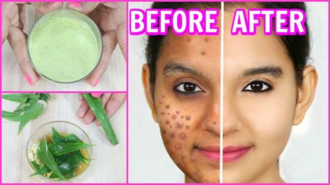 Remove Pimples Permanently (100% Results) - DIY Face Wash, Spot ...