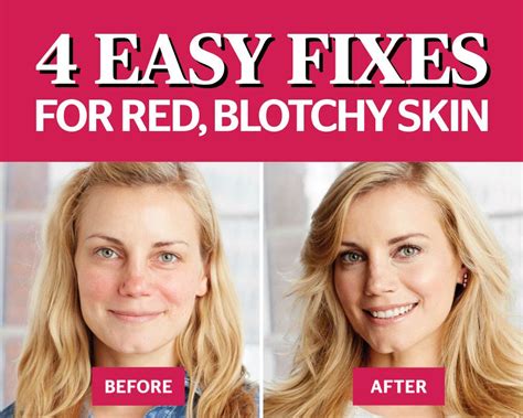 4 Easy Hacks To Get Rid Of Red, Blotchy Skin. If you have sensitive ...