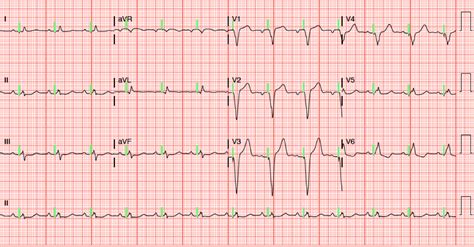 Dr. Smith's ECG Blog: A patient with a ventricular paced rhythm and ...