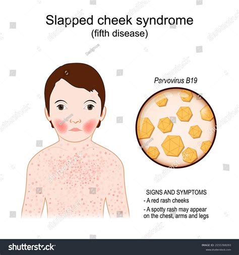 Fifth disease. Signs and symptoms. child has - Royalty Free Stock ...