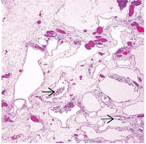 Lymphangioma and Lymphangiomatosis | Basicmedical Key