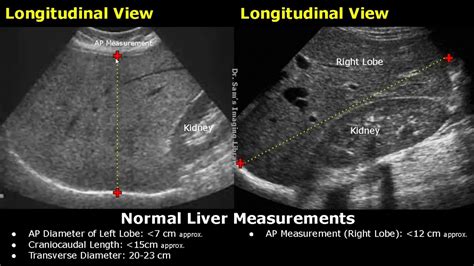 How To Measure Liver On Ultrasound | Craniocaudal Length, Transverse ...