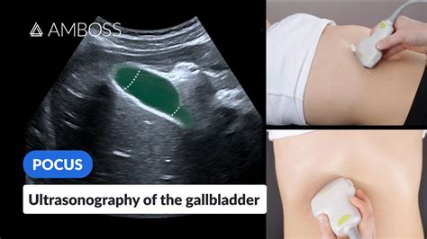 Point of Care Ultrasound of the Gallbladder - AMBOSS Video - YouTube