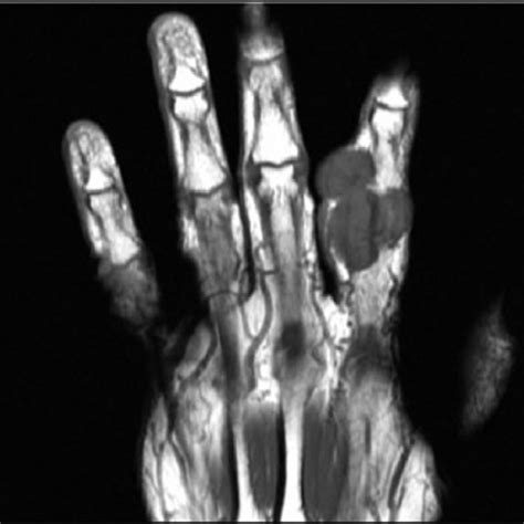 Showing MRI GCTTS of the left index finger. | Download Scientific Diagram