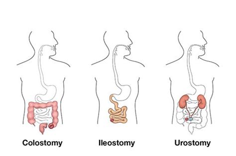 Health Hacks: Ostomy: Things You May Want To Know