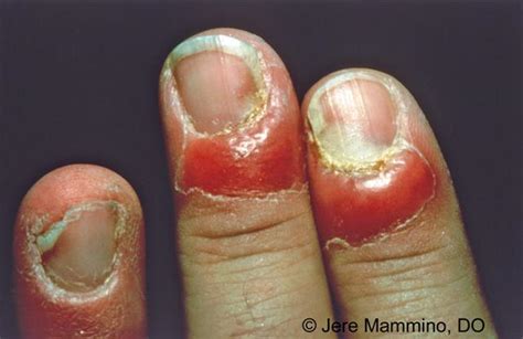 Paronychia Nail Infection - American Osteopathic College of Dermatology ...