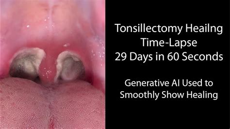 Healing Time Lapse After Tonsillectomy: 0-29 Days in 60 Seconds - YouTube