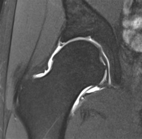 MRI Hip/Pelvis Arthrogram - Mediphany