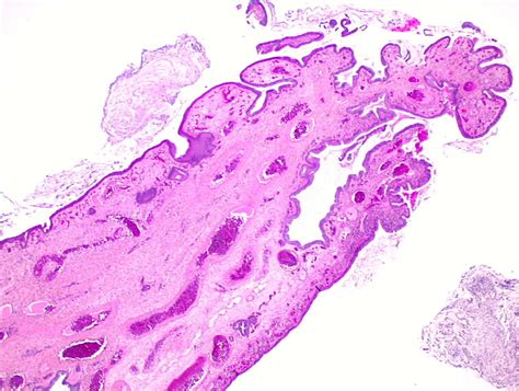 Pathology Outlines - Endocervical polyp