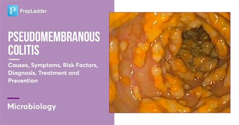 Pseudomembranous Colitis: Causes, Symptoms, Diagnosis & Treatment