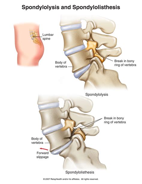 Spondylolysis and Spondylolisthesis