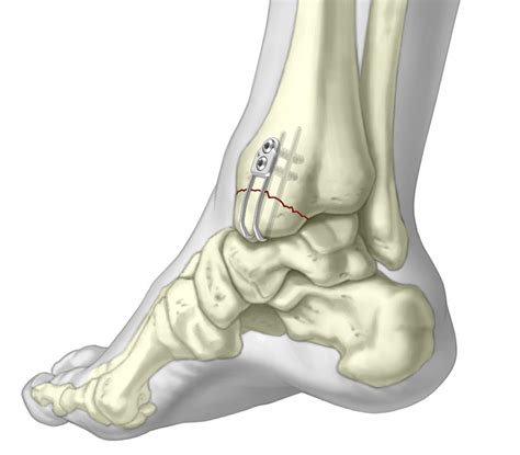 Medial Malleolus