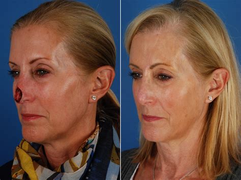 Skin Cancer Reconstruction Photos | Naples, FL | Patient 10767