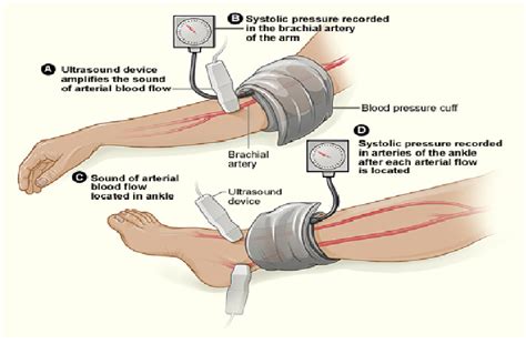 Arterial Doppler Study with ABI - Glendale Heart Institute | Cardiology ...