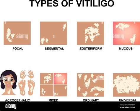 Types of vitiligo. World Vitiligo Day. Infographics. Vector ...