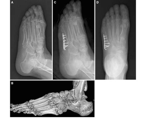 A 64-year-old woman with a fifth metatarsal base fracture. a ...