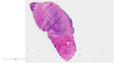 Mucocele Histology