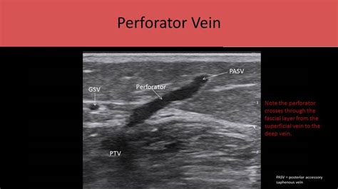 Ultrasound Registry Review - Extremity Venous | Diagnostic medical ...