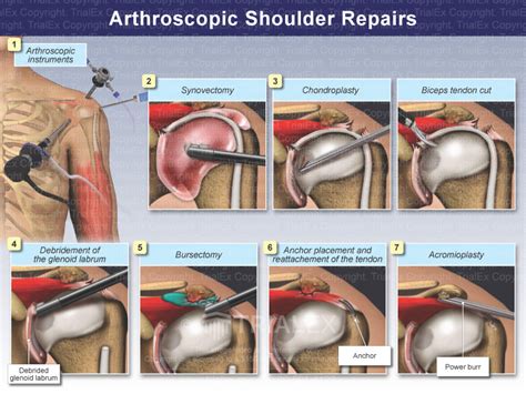 Arthroscopic Shoulder Repairs - TrialQuest Inc.