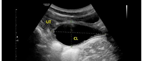 Cloacal malformation of a newborn. There is an abdominal mass with a ...