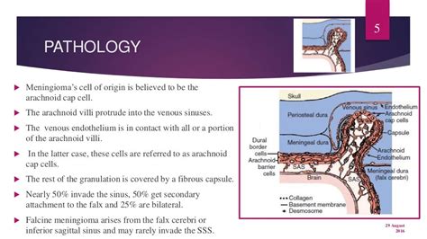 Meningioma falcine and parasagittal