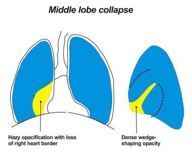 Middle Lobe Syndrome; Brock's Syndrome