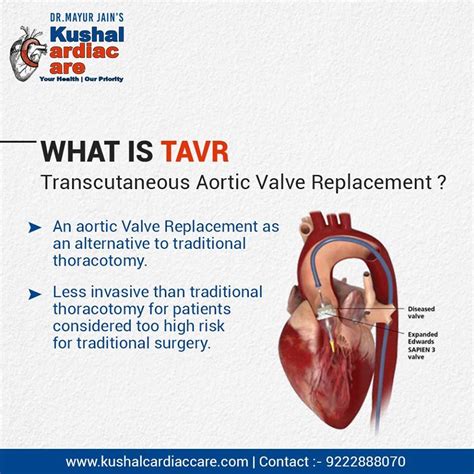 WHAT IS TAVR (TRANSCUTANEOUS AORTIC VALVE REPLACEMENT) | Aortic valve ...