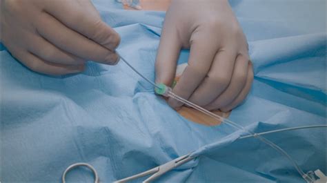 Right Heart Catheterization • MyHeart