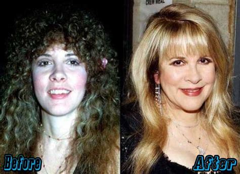 Stevie Nicks Plastic Surgery Before and After