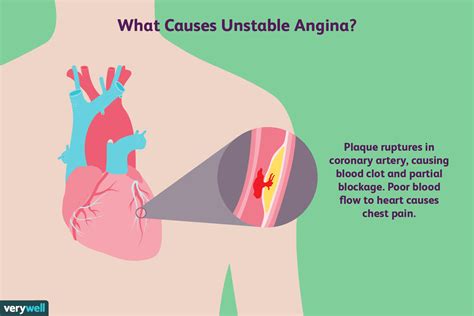 Unstable Angina: Symptoms, Causes, Diagnosis, and More