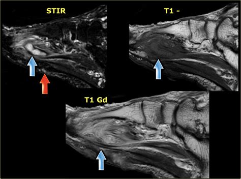 Foot Anatomy Mri Radiology