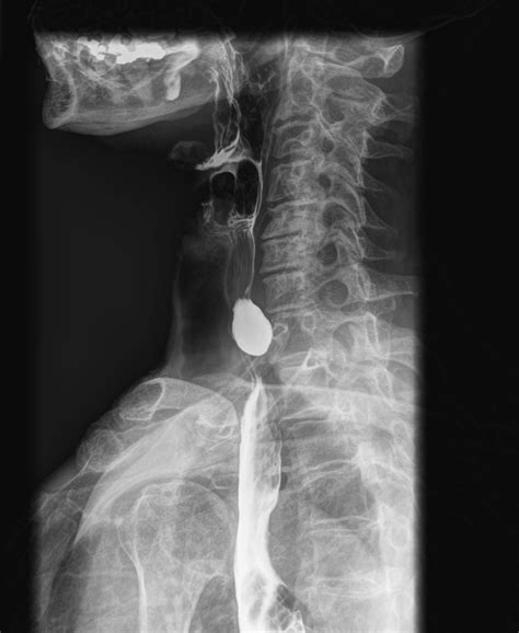 Zenker Diverticulum Barium Swallow