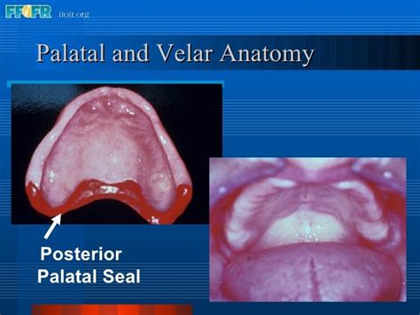 26.posterior palatal seal