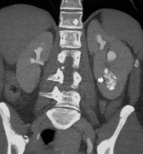 Medullary Sponge Kidney - Genitourinary Disorders - MSD Manual ...