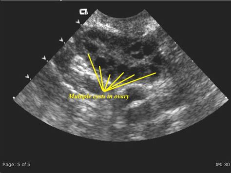 Pcos Ovary Ultrasound